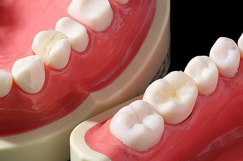 セラミックインレーのメリット・デメリット