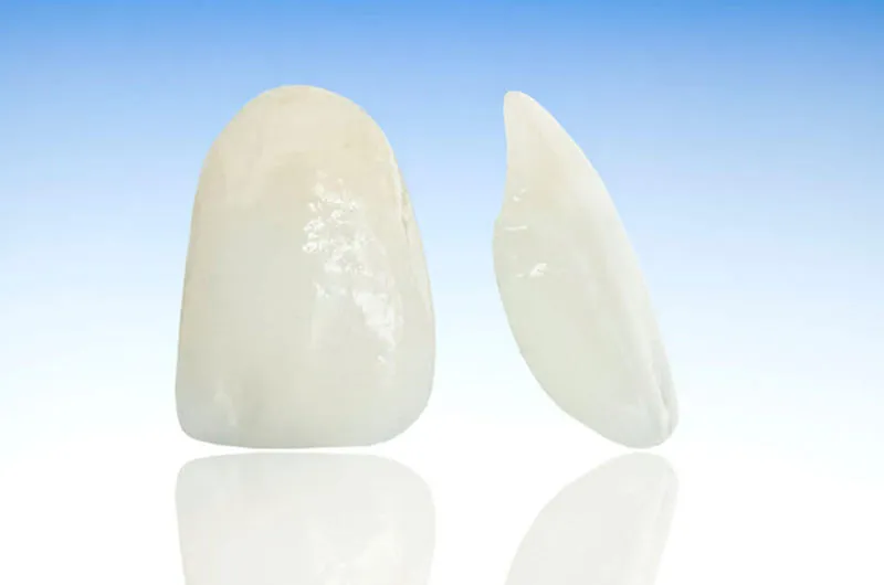 ラミネートべニアのメリット・デメリット