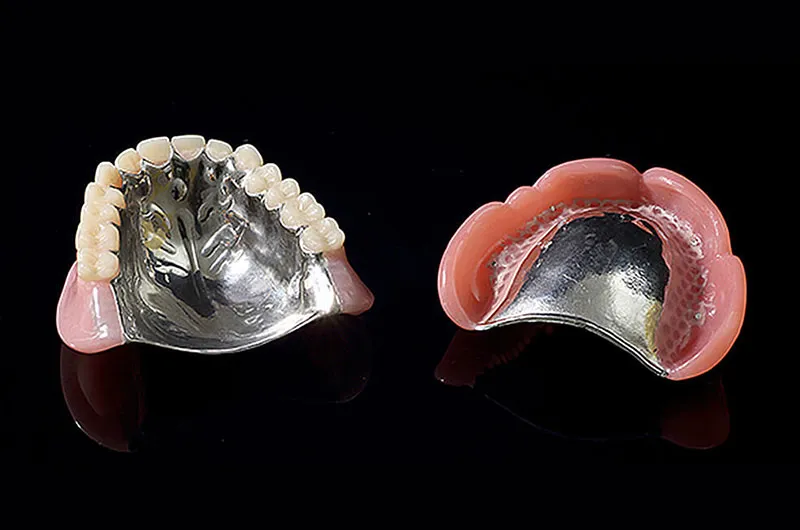 金属床の入れ歯