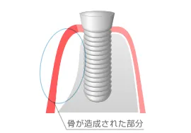 ①GBR・骨誘導再生法