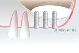 ②サイナスリフト法