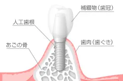 インプラント