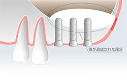 サイナスリフト