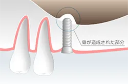 ソケットリフト